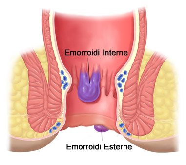 Emorroidi Interne ed Esterne