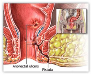 fistole-anali